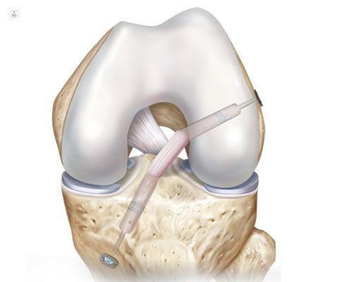 reconstruccion-ligamento