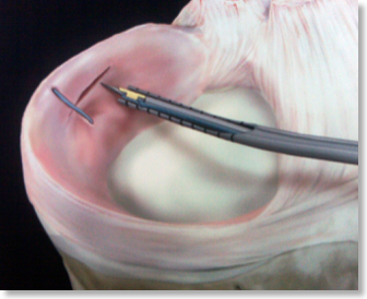 reparacion-meniscal